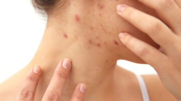 A sarna é contagiosa