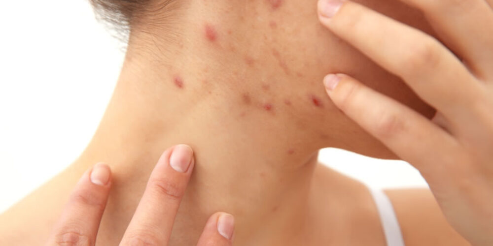A sarna é contagiosa