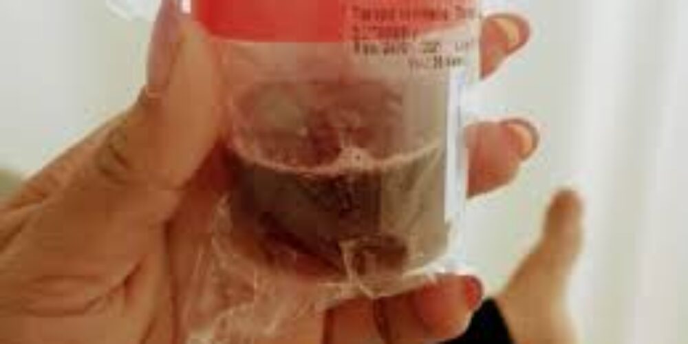 Como fica a urina de quem tem dengue