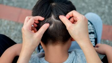 Como remover lêndeas do cabelo em casa