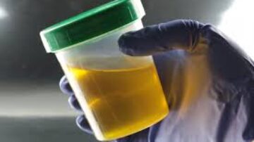 Dengue deixa urina amarela