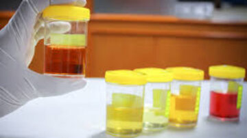 Dengue e a urina laranja