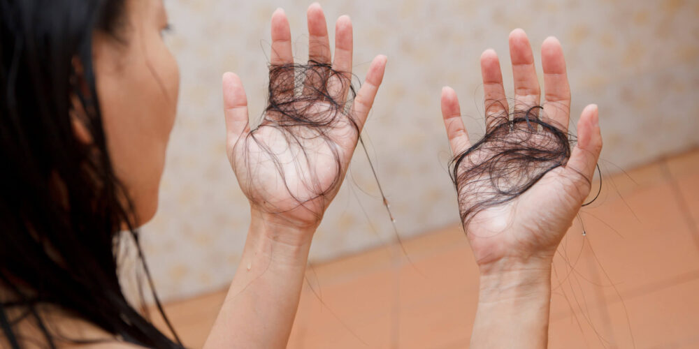 Dengue faz o cabelo cair