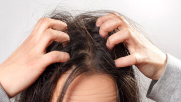 É possível ter pulga no cabelo