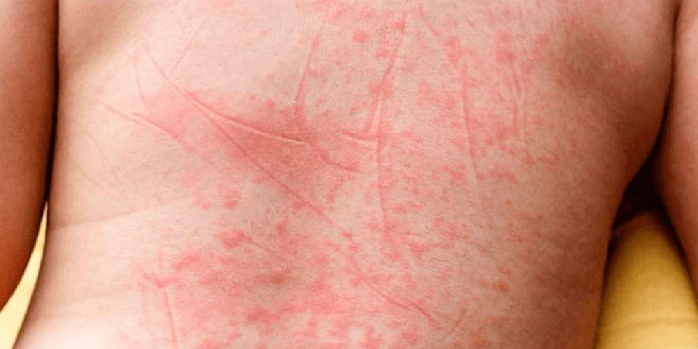 Em que fase da dengue aparecem as manchas vermelhas