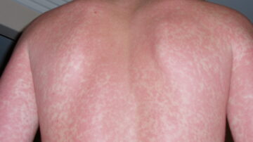Manchas vermelhas na pele da dengue