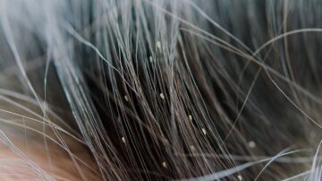 Pentear piolhos e lêndeas
