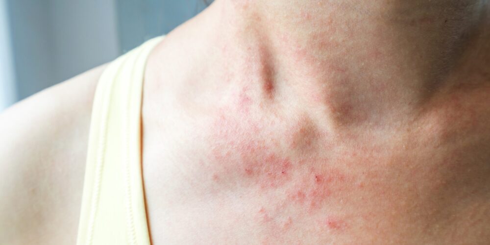 Porque dengue coça tanto