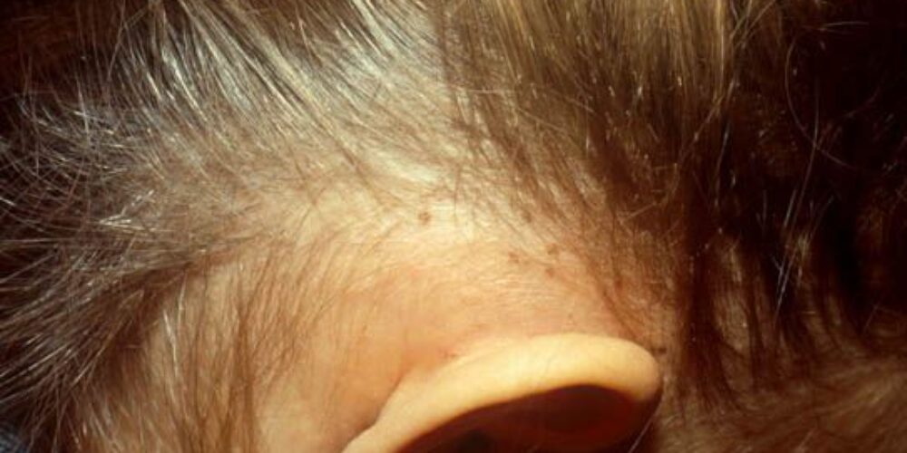 Quais são os sintomas de infestação por piolhos