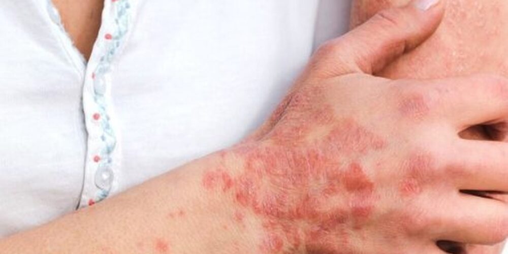 Qual é a pior fase da dengue