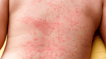 Sintomas finais da dengue