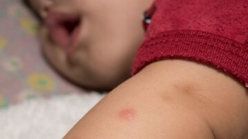 Tratamento infantil da dengue